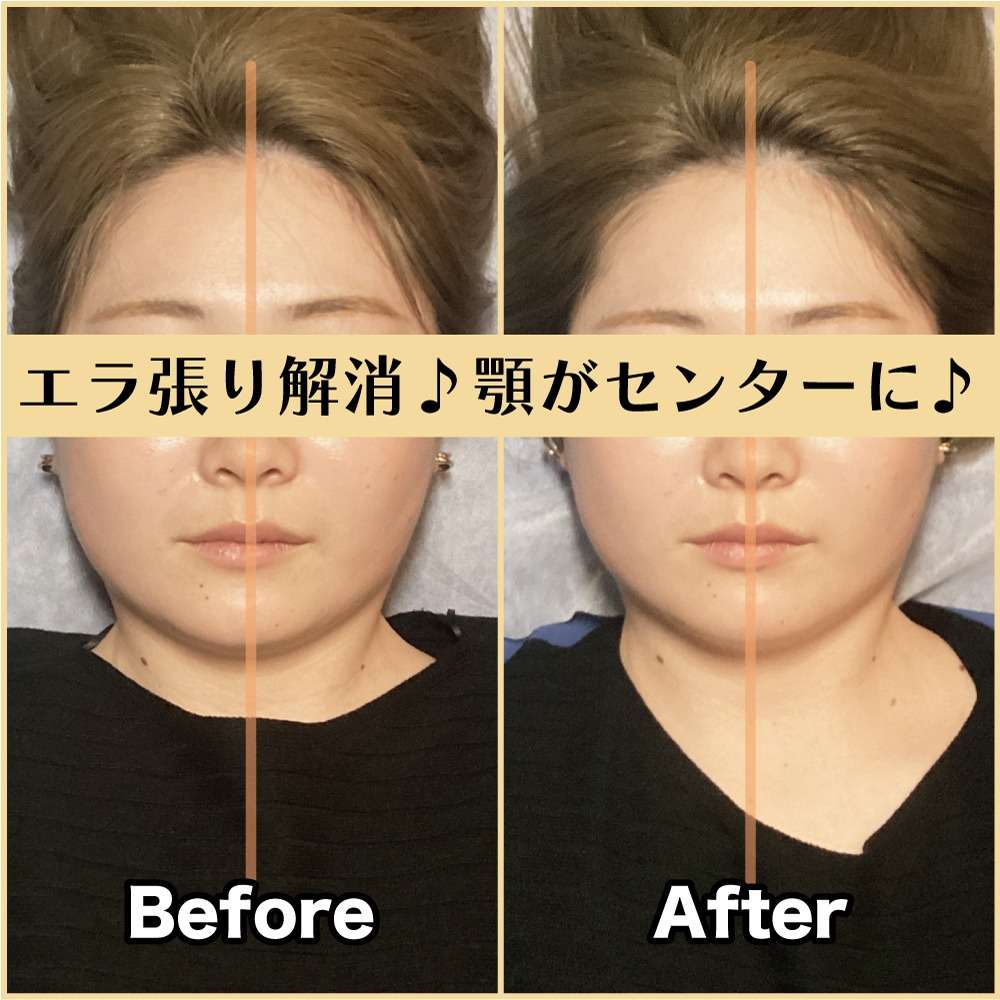 筋膜小顔矯正ビフォー＆アフター！エラ張りを改善♪｜筋膜整体はたやまきんま君 本町店