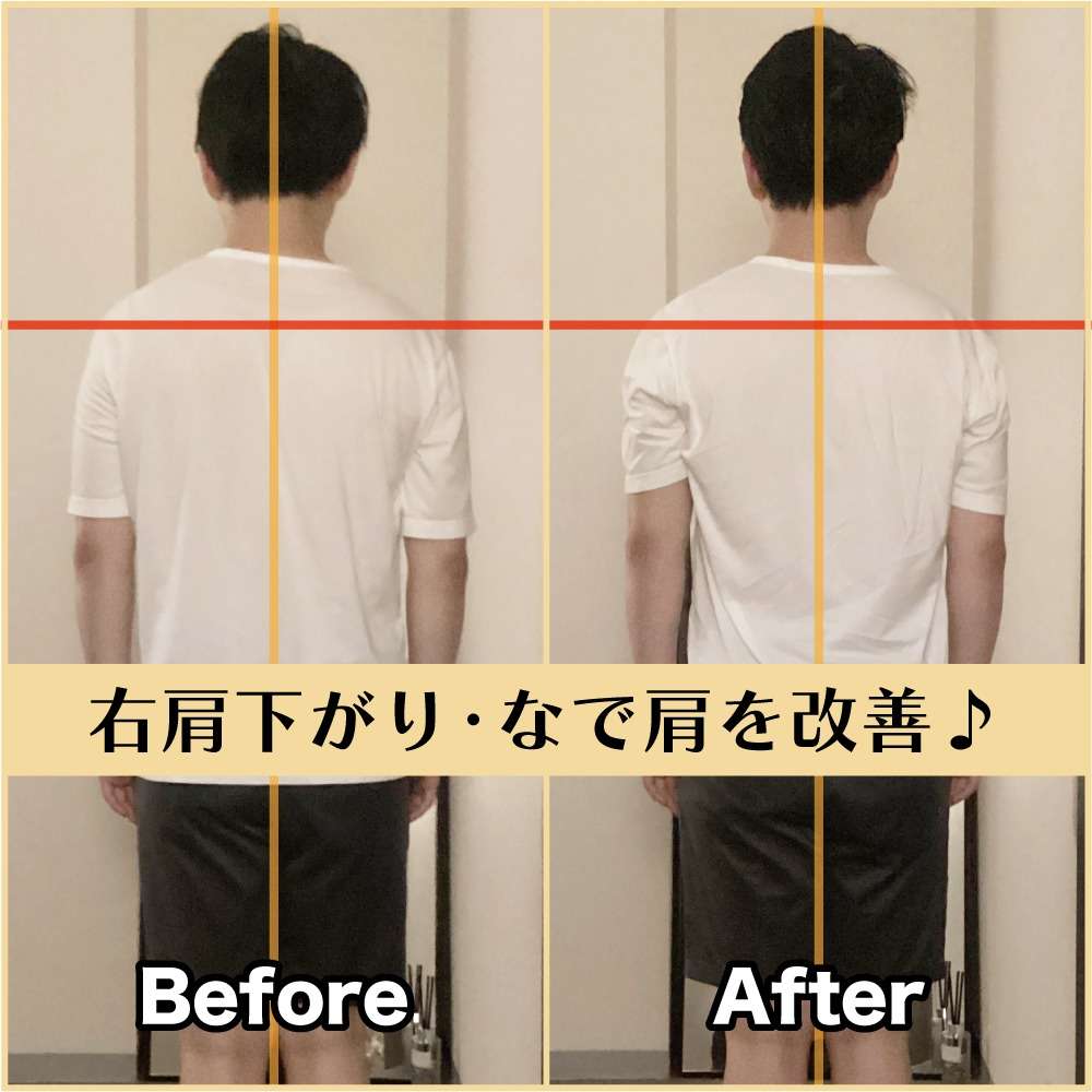 筋膜整体ビフォー＆アフター！なで肩を改善♪｜筋膜整体はたやまきんま君 本町店