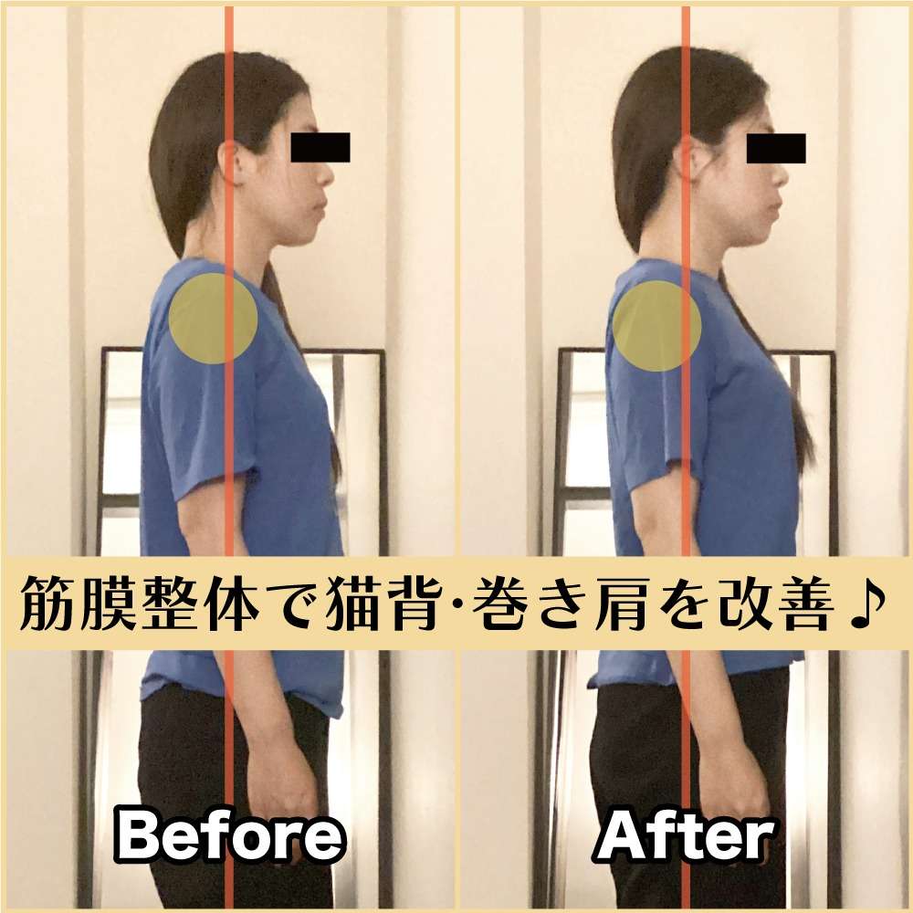 筋膜整体ビフォー＆アフター！猫背・巻き肩を改善♪｜筋膜整体はたやまきんま君 本町店