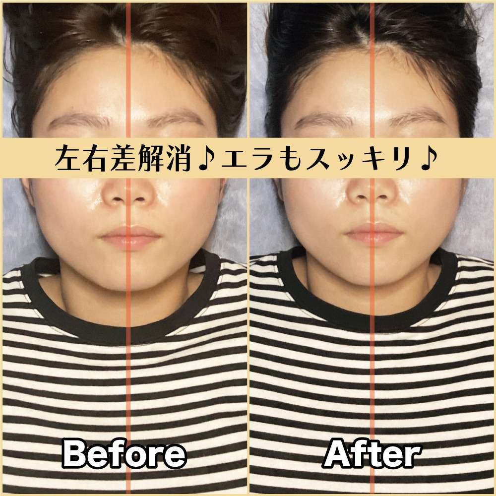 筋膜小顔矯正ビフォー＆アフター！エラ張りを解消♪｜筋膜整体はたやまきんま君 本町店