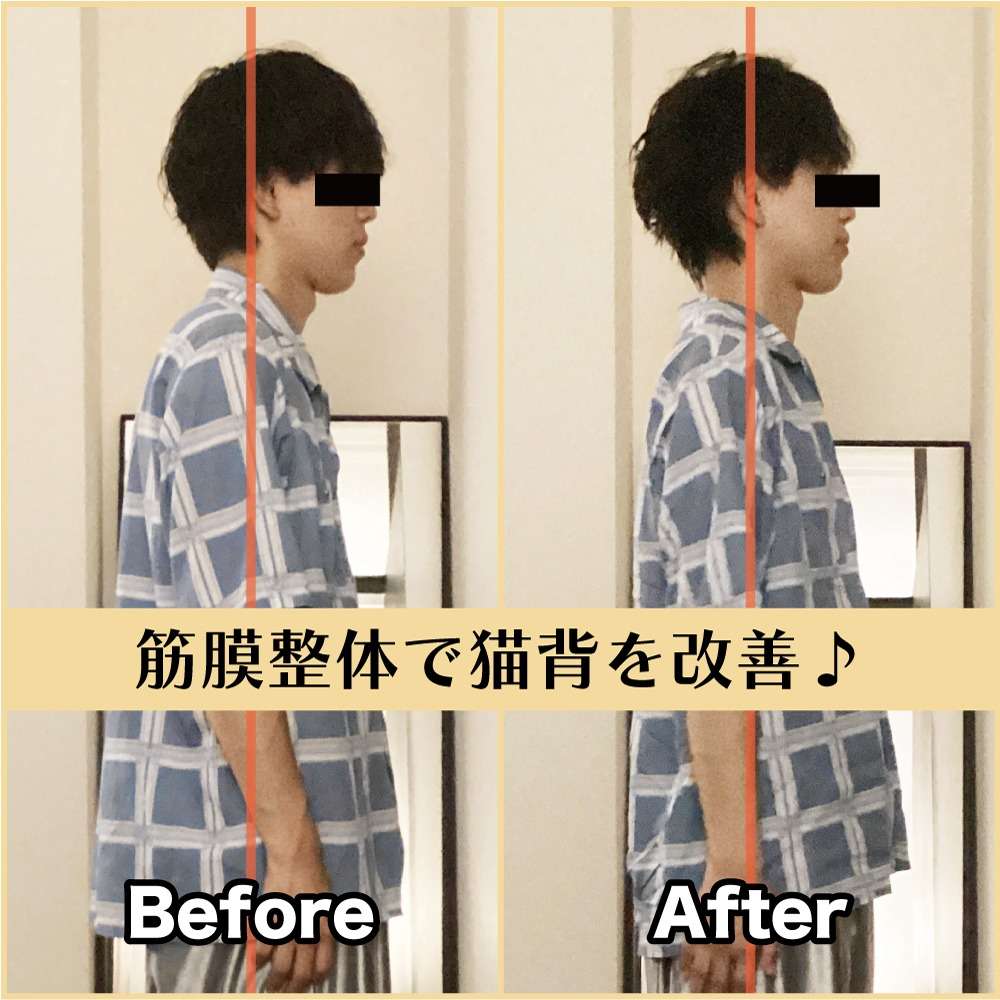 筋膜整体ビフォー＆アフター！猫背を改善♪｜筋膜整体はたやまきんま君 本町店