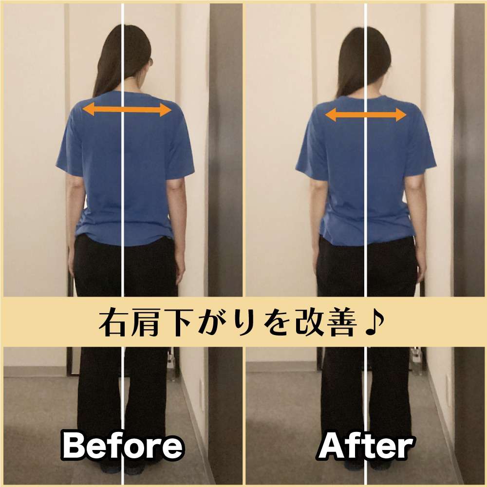 筋膜整体ビフォー&アフター!身体の歪みを改善♪|筋膜整体はたやまきんま君 本町店