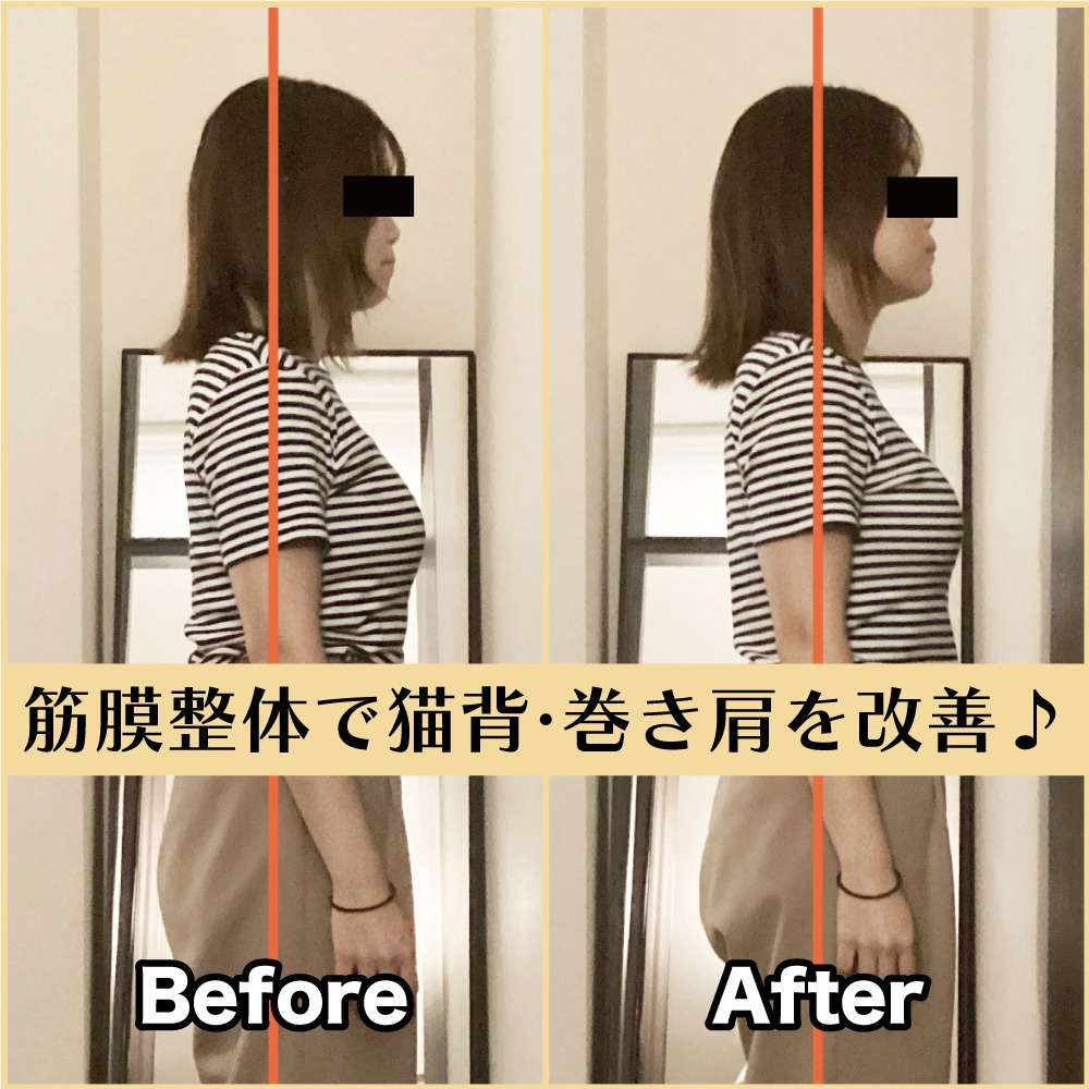 筋膜整体ビフォー&アフター!猫背・巻き肩が原因でした😭|筋膜整体はたやまきんま君 本町店