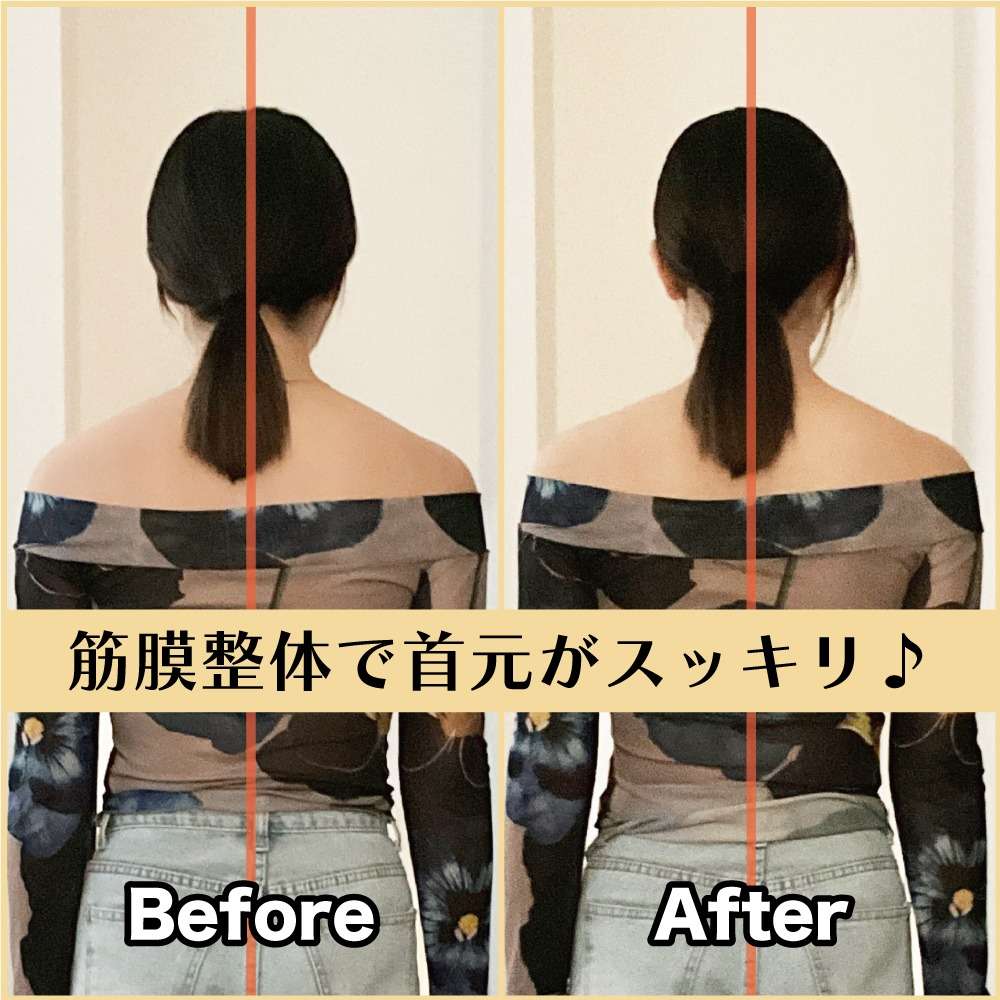 筋膜整体ビフォー＆アフター！巻き肩改善で首元スッキリ💫｜筋膜整体はたやまきんま君 本町店