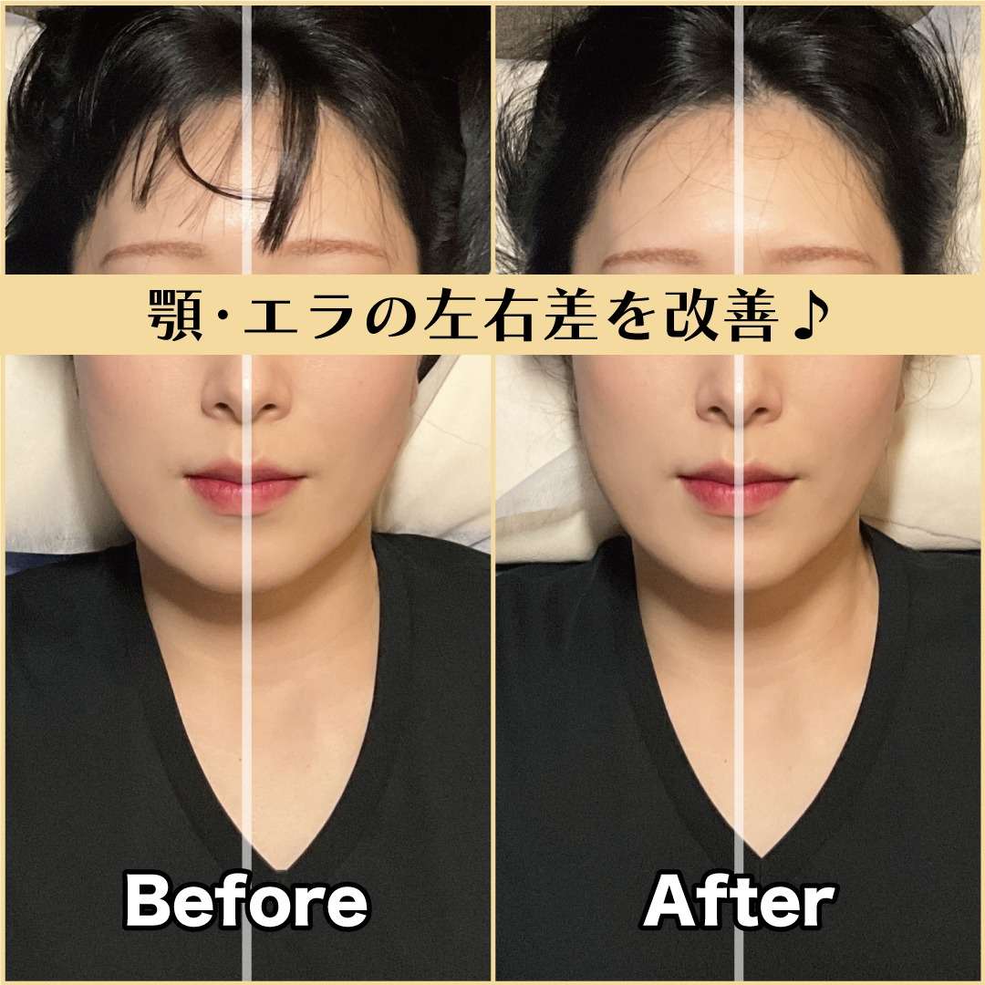 筋膜小顔矯正ビフォー&アフター!顎とエラの左右差を改善♪|筋膜整体はたやまきんま君 本町店