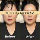 筋膜小顔矯正ビフォー＆アフター！顎とエラの左右差を改善♪｜筋膜整体はたやまきんま君 本町店